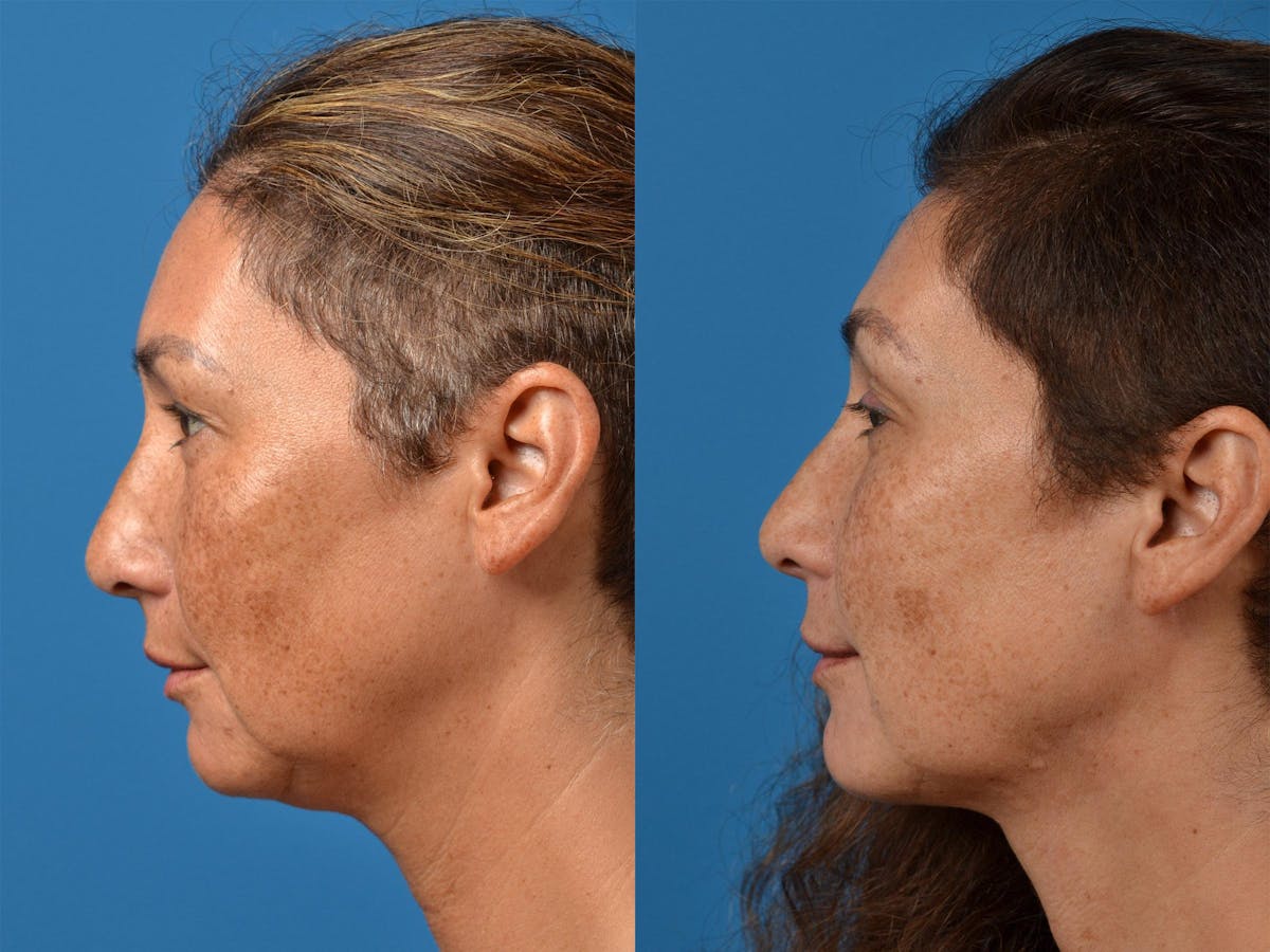 Laser Assisted Weekend Neck Lift Before & After Gallery - Patient 122406537 - Image 5