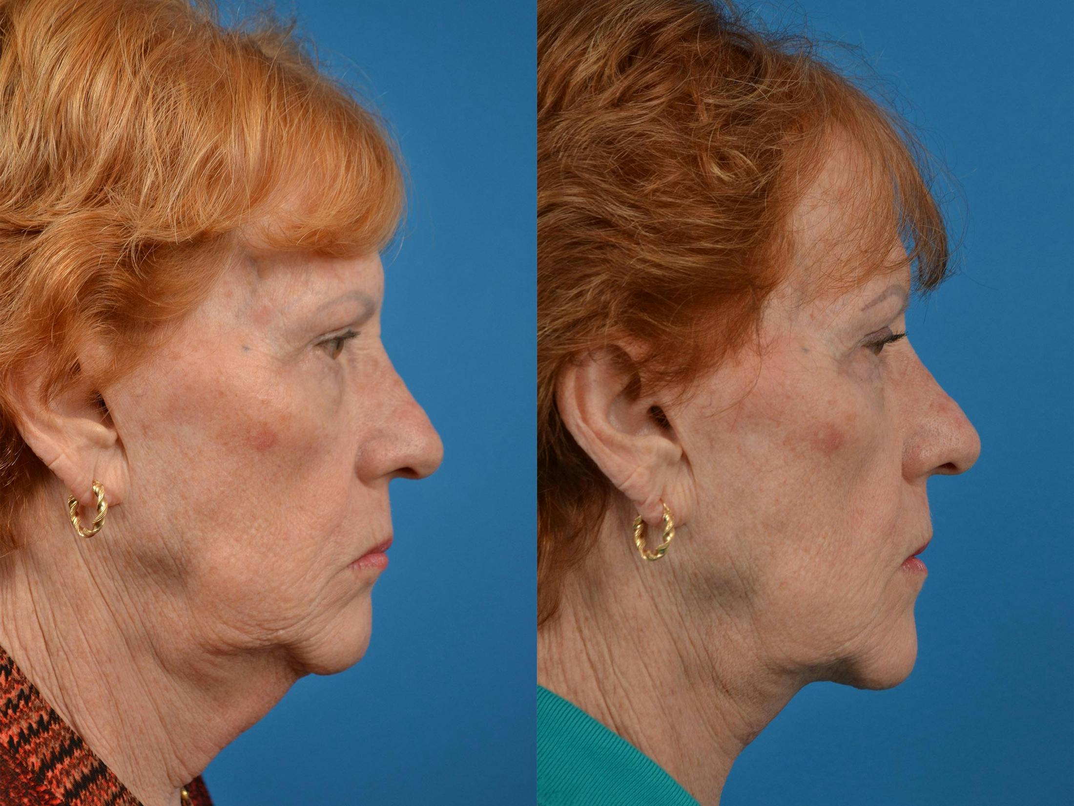 Profile Neck Lift Before & After Gallery - Patient 122406539 - Image 3