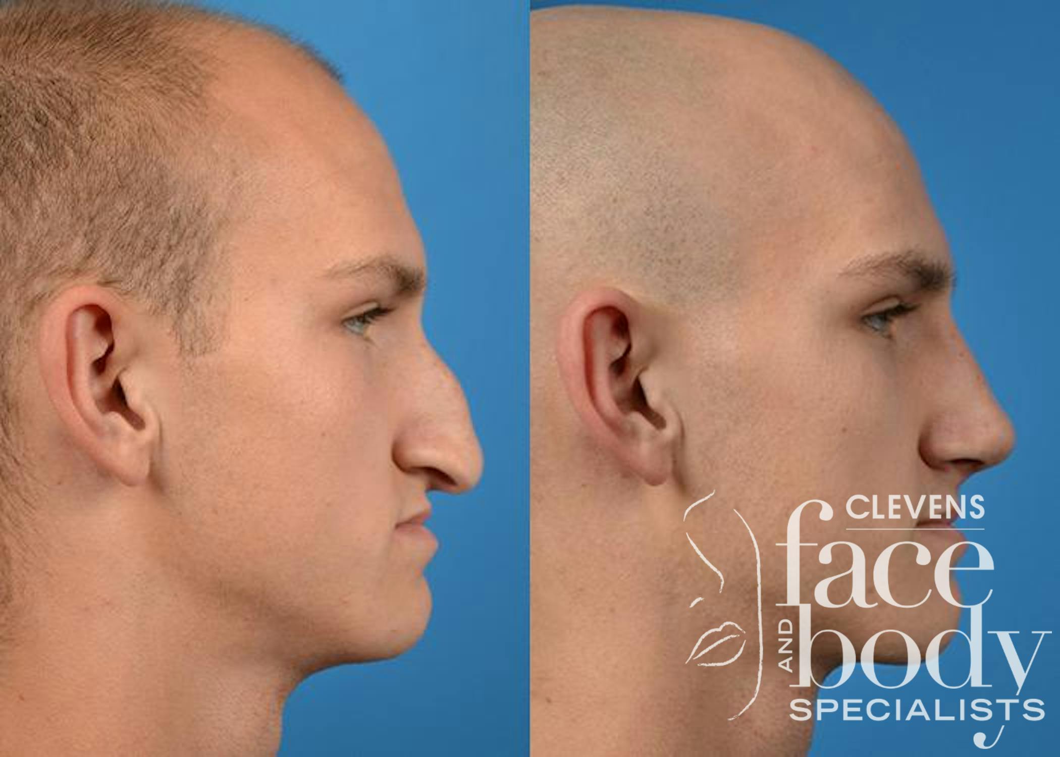 Rhinoplasty Procedure