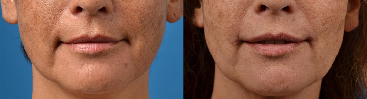 Laser Assisted Weekend Neck Lift Before & After Gallery - Patient 122406537 - Image 6