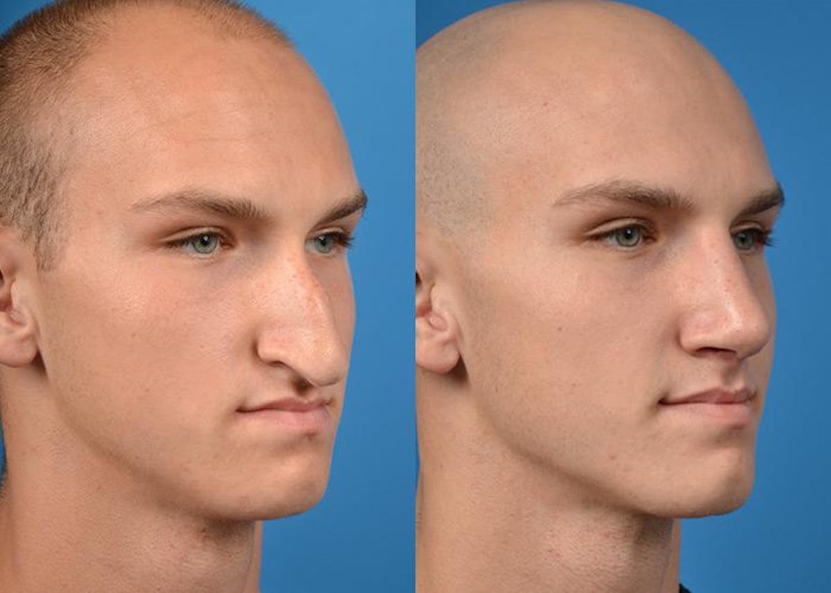 Rhinoplasty Before & After Gallery - Patient 122406538 - Image 2