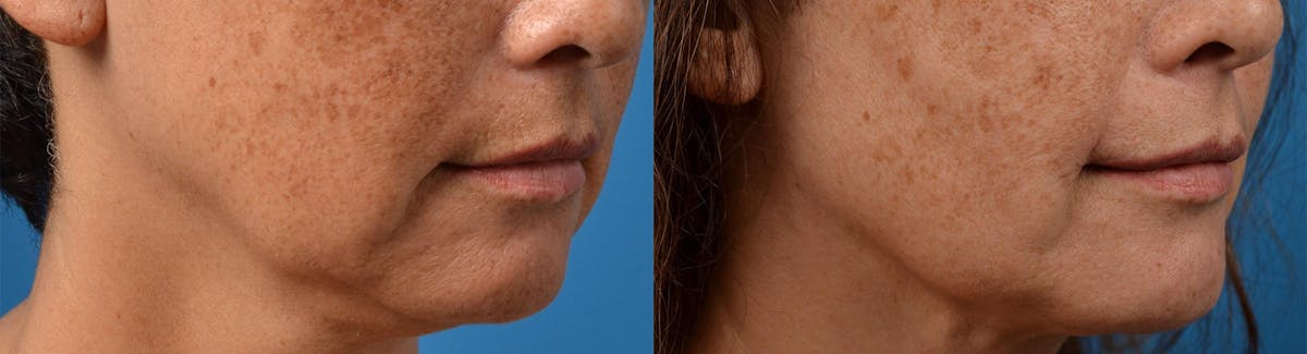 Laser Assisted Weekend Neck Lift Before & After Gallery - Patient 122406537 - Image 7