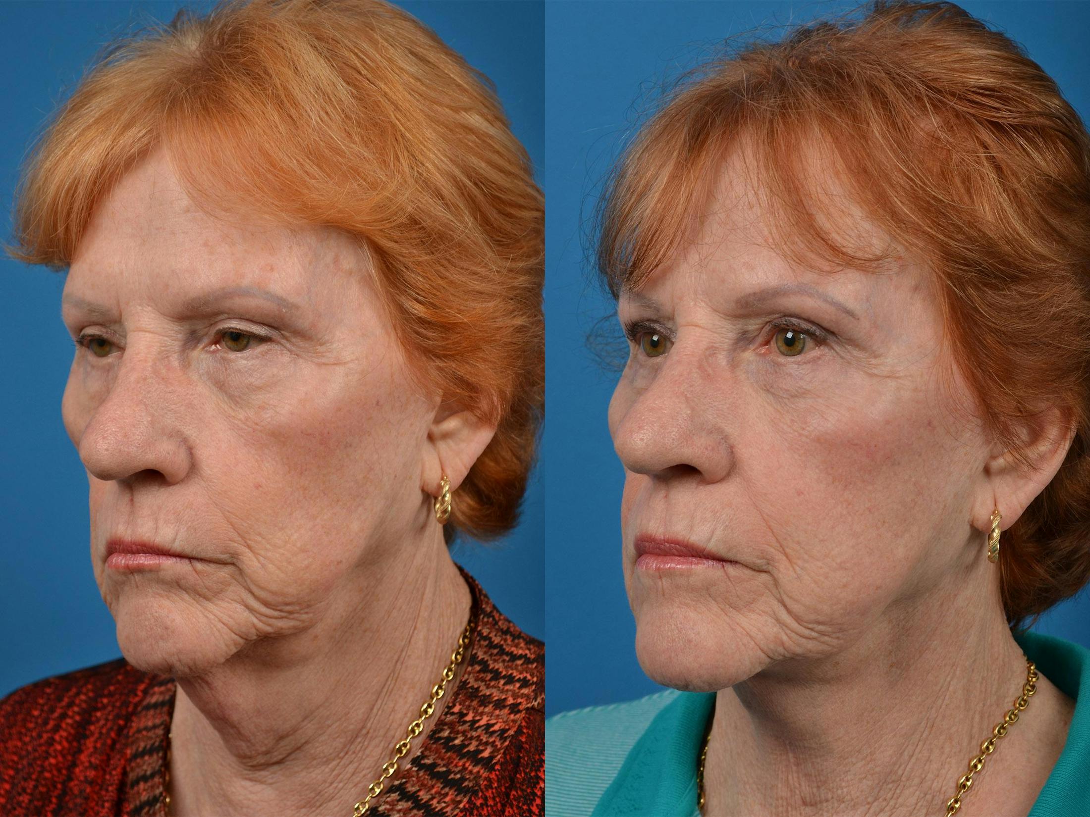 Profile Neck Lift Before & After Gallery - Patient 122406539 - Image 4