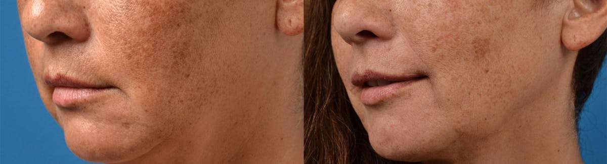 Laser Assisted Weekend Neck Lift Before & After Gallery - Patient 122406537 - Image 8