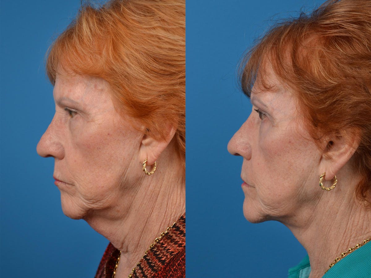Profile Neck Lift Before & After Gallery - Patient 122406539 - Image 5