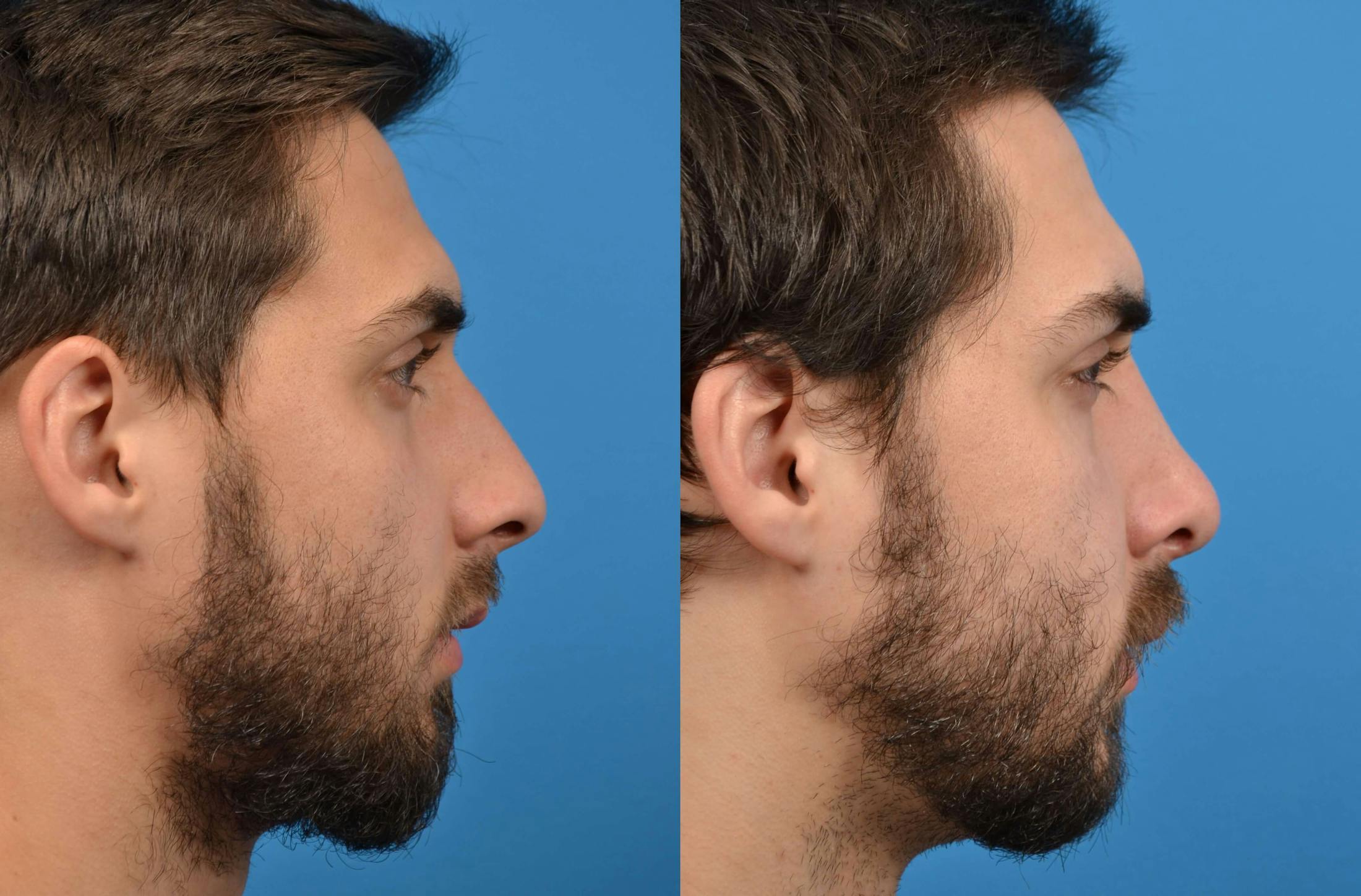 Rhinoplasty Before & After Gallery - Patient 122406543 - Image 1