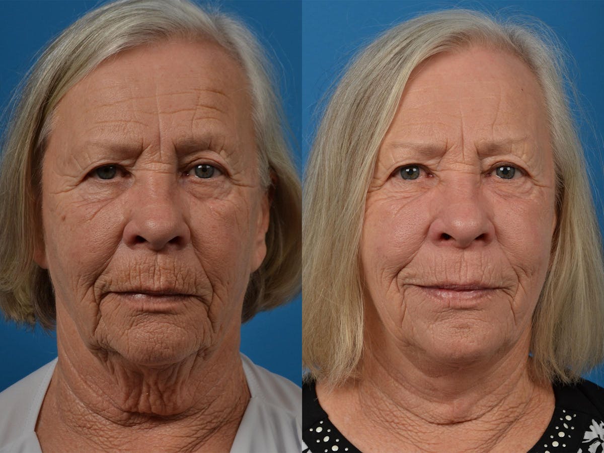 Profile Neck Lift Before & After Gallery - Patient 122406541 - Image 1