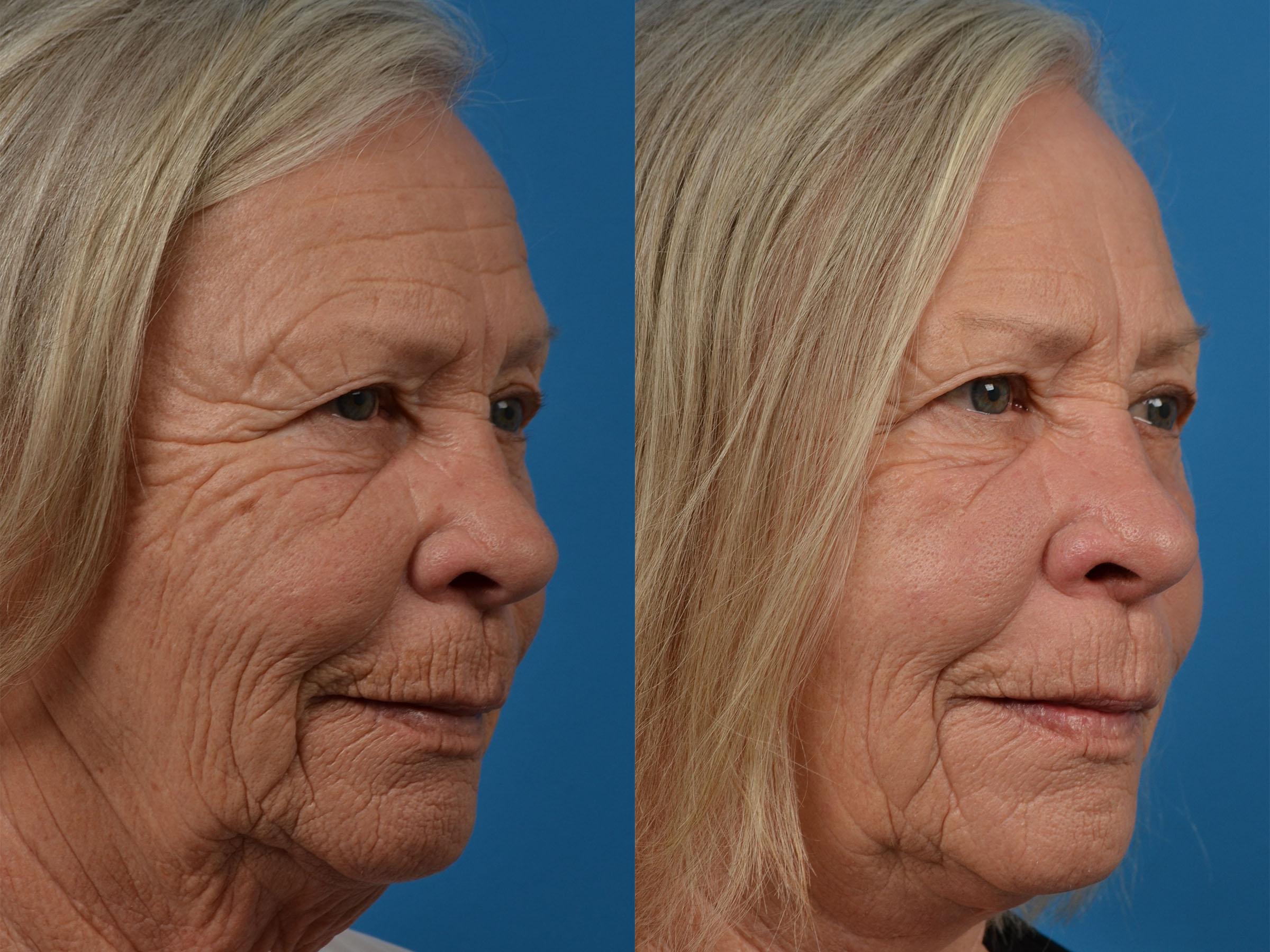 Profile Neck Lift Before & After Gallery - Patient 122406541 - Image 2