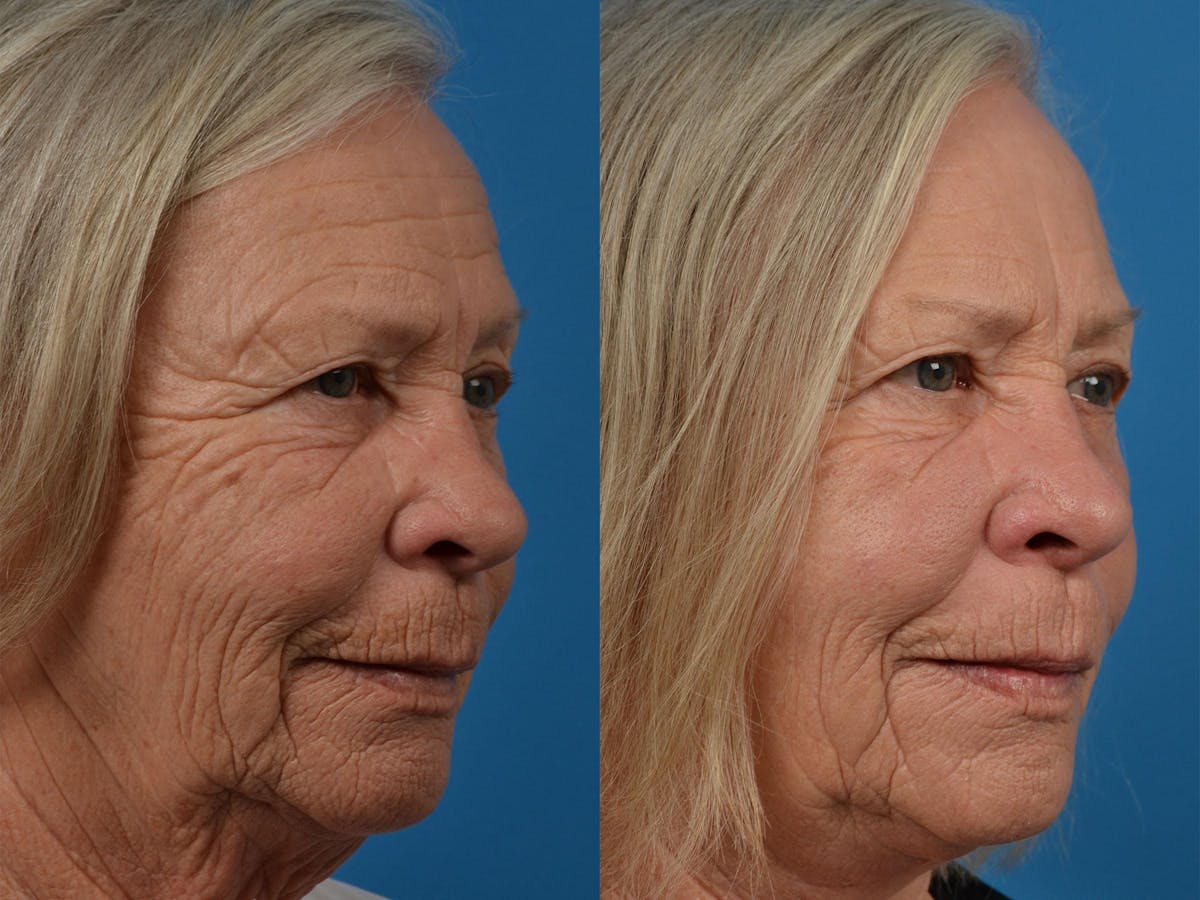 Profile Neck Lift Before & After Gallery - Patient 122406541 - Image 2