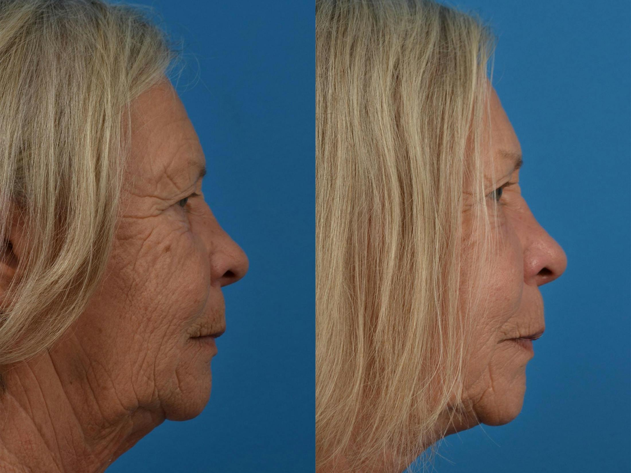Profile Neck Lift Before & After Gallery - Patient 122406541 - Image 3