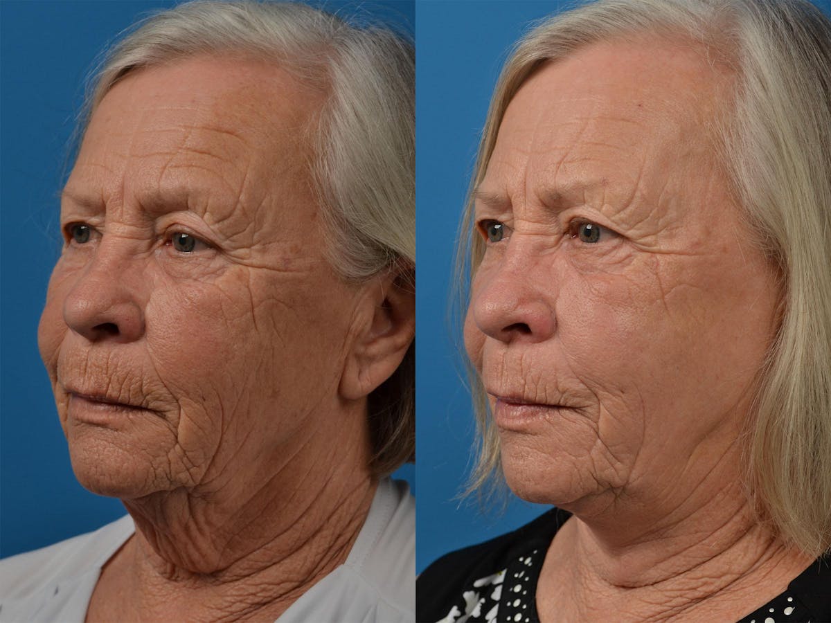 Profile Neck Lift Before & After Gallery - Patient 122406541 - Image 4