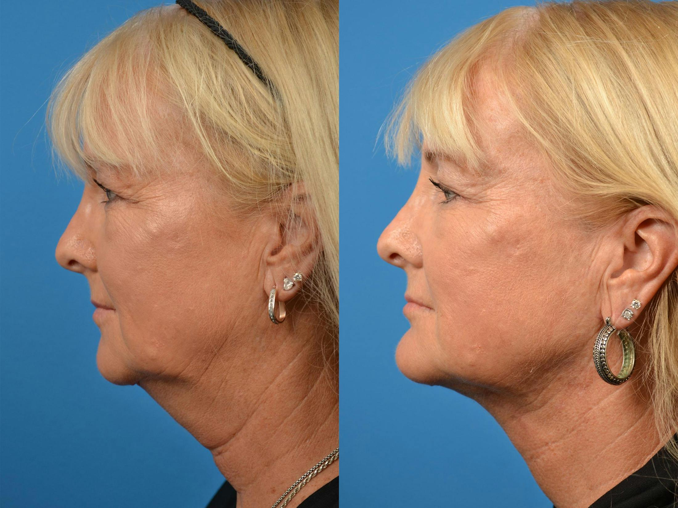 Laser Assisted Weekend Neck Lift Before & After Gallery - Patient 122406540 - Image 5