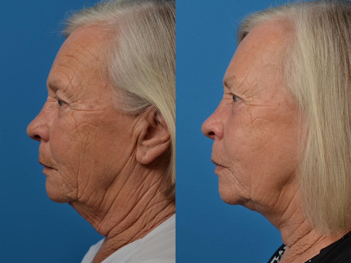 Profile Neck Lift Before & After Gallery - Patient 122406541 - Image 5
