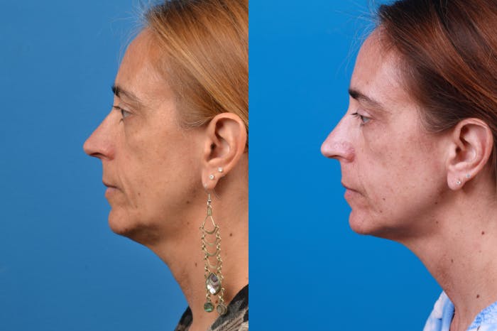 Laser Assisted Weekend Neck Lift Before & After Gallery - Patient 122406547 - Image 1