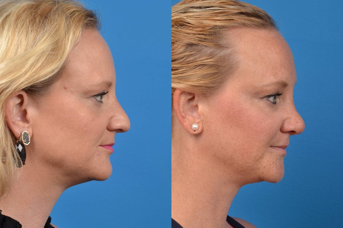 Rhinoplasty Before & After Gallery - Patient 122406552 - Image 1