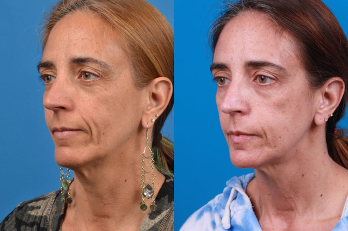Laser Assisted Weekend Neck Lift Before & After Gallery - Patient 122406547 - Image 2