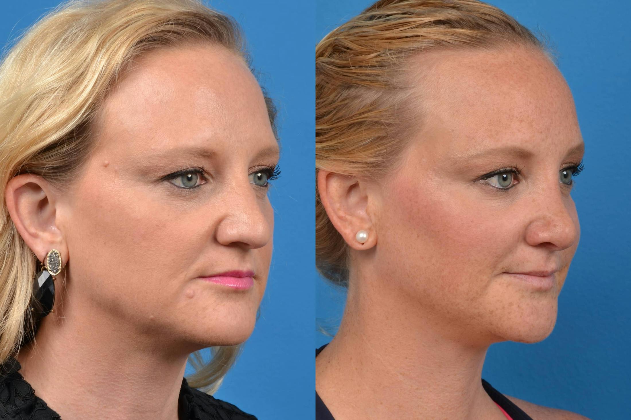 Rhinoplasty Before & After Gallery - Patient 122406552 - Image 2