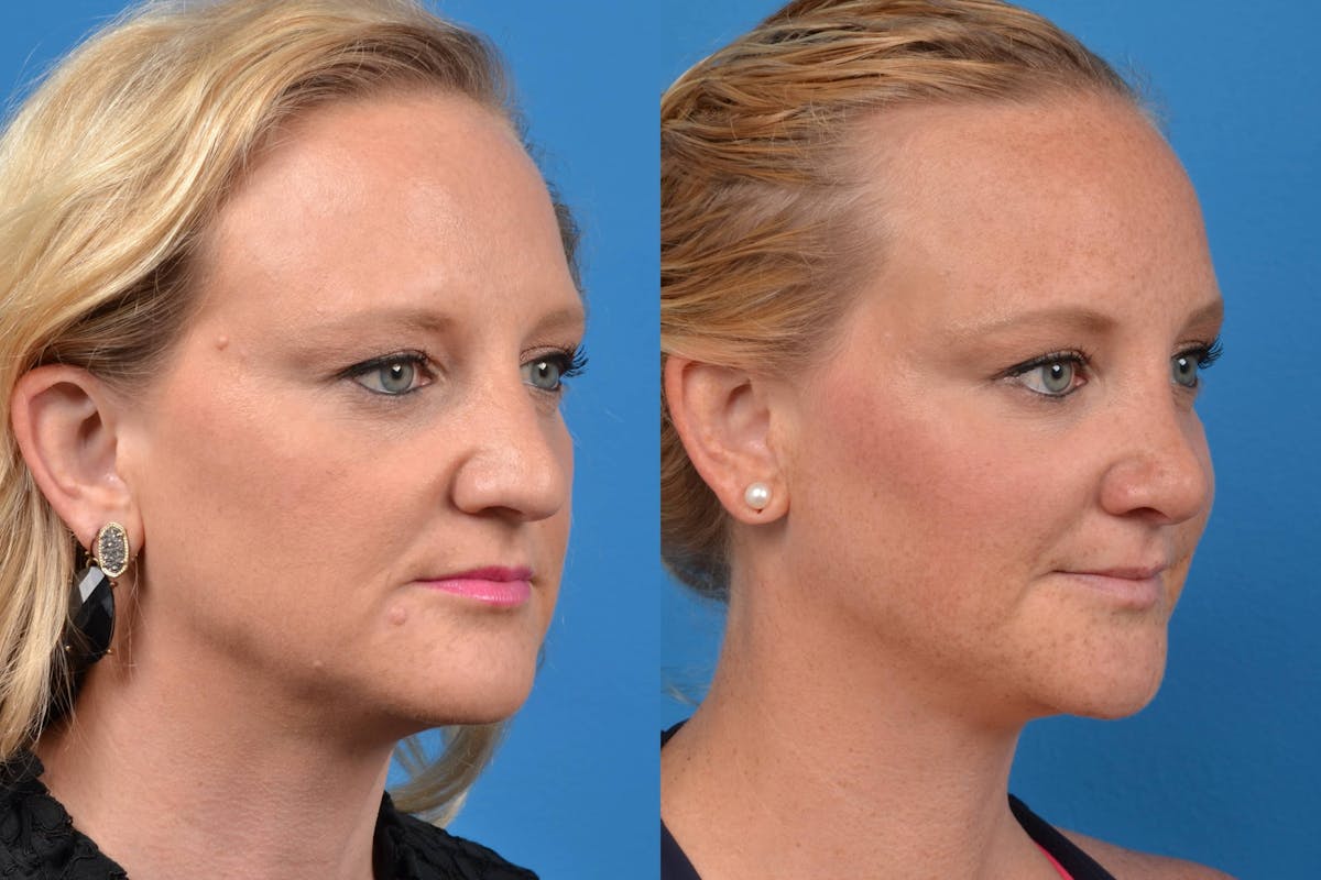 Rhinoplasty Before & After Gallery - Patient 122406552 - Image 2