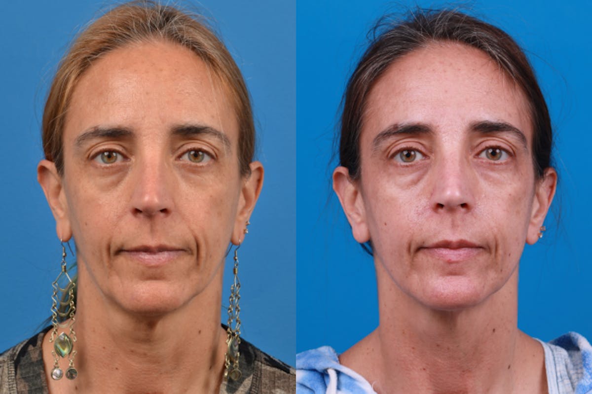 Laser Assisted Weekend Neck Lift Before & After Gallery - Patient 122406547 - Image 3