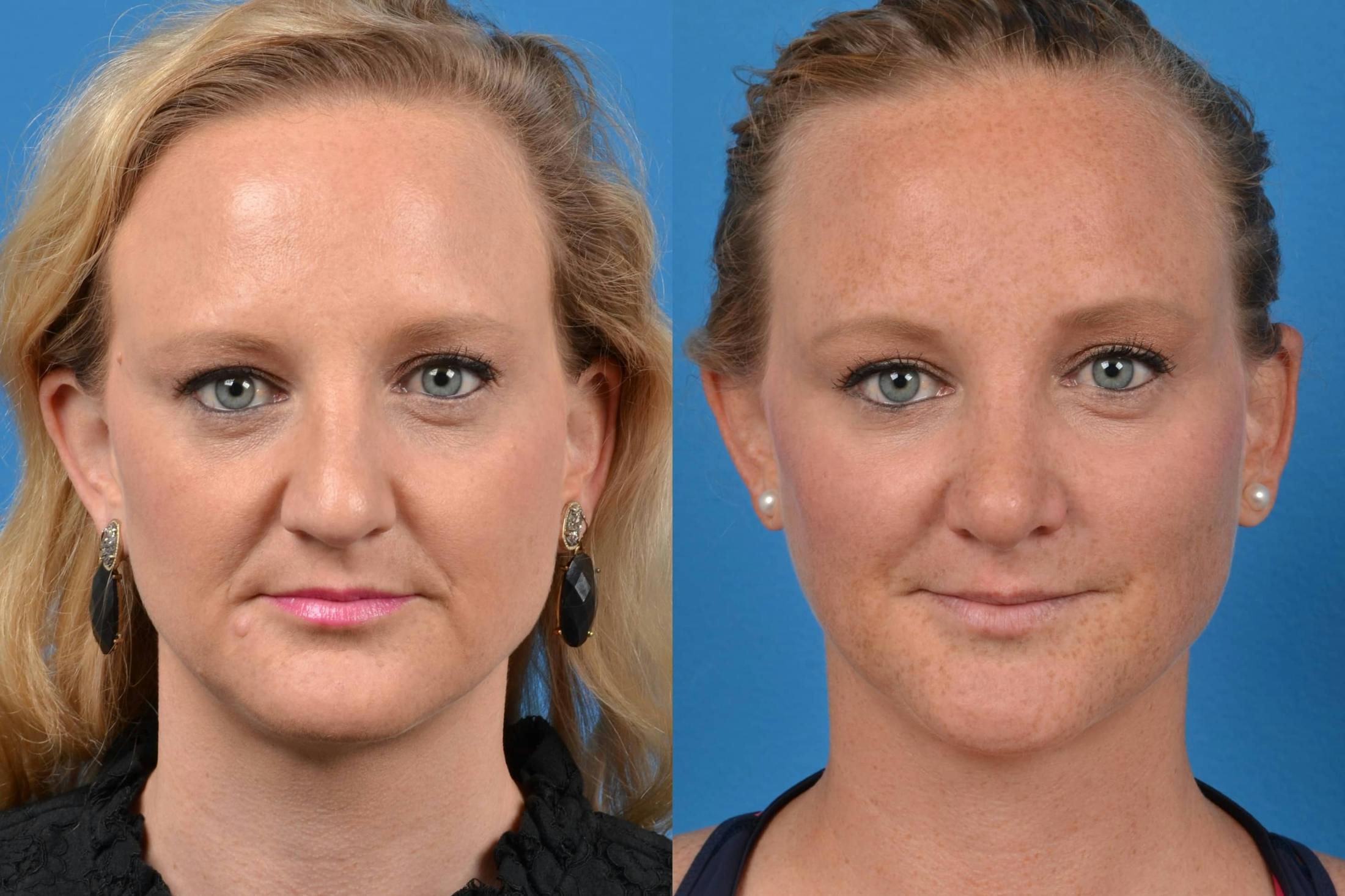 Rhinoplasty Before & After Gallery - Patient 122406552 - Image 3