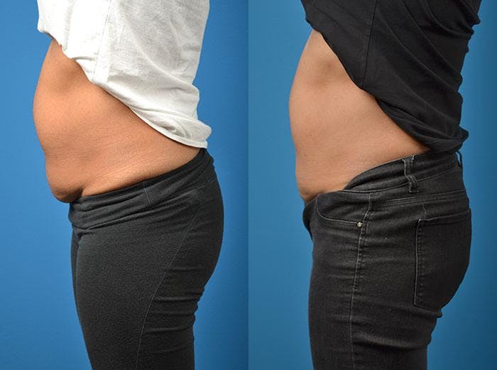 SculpSure Body Contouring Before & After Gallery - Patient 122406545 - Image 1