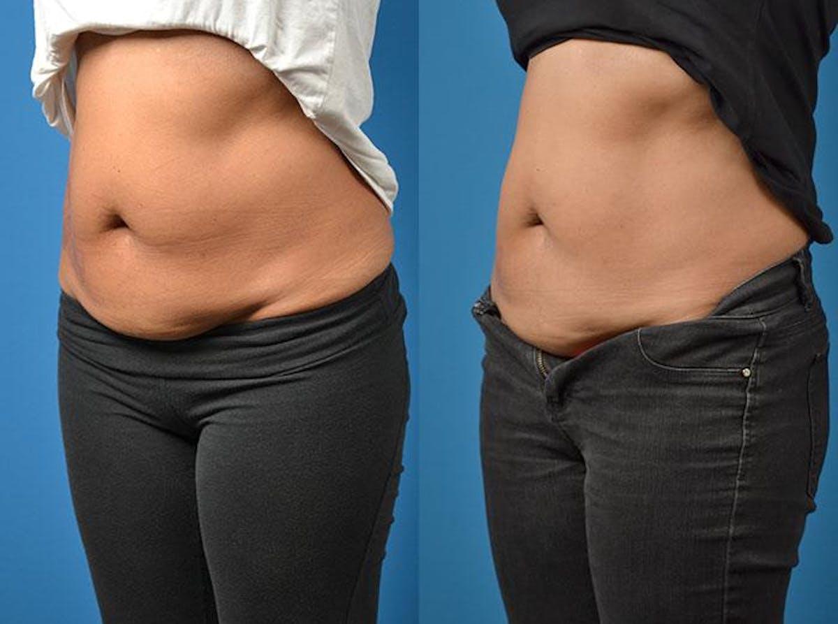 SculpSure Body Contouring Before & After Gallery - Patient 122406545 - Image 2