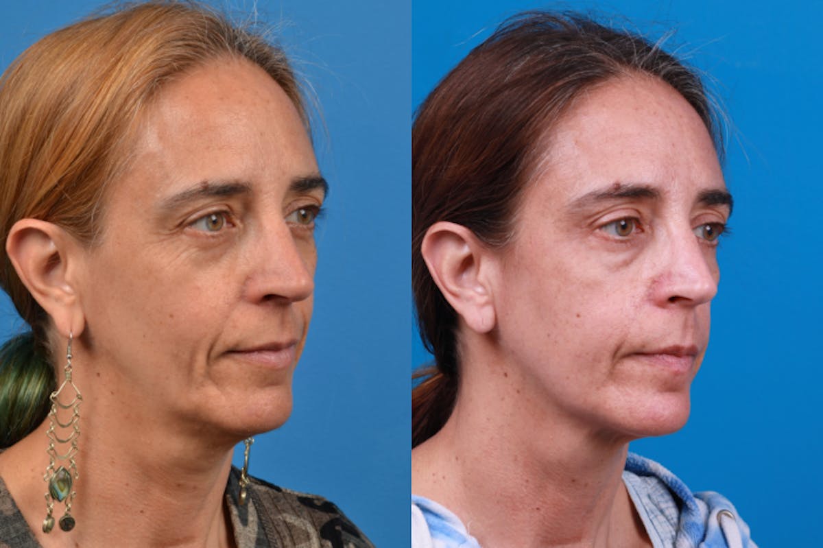 Laser Assisted Weekend Neck Lift Before & After Gallery - Patient 122406547 - Image 4