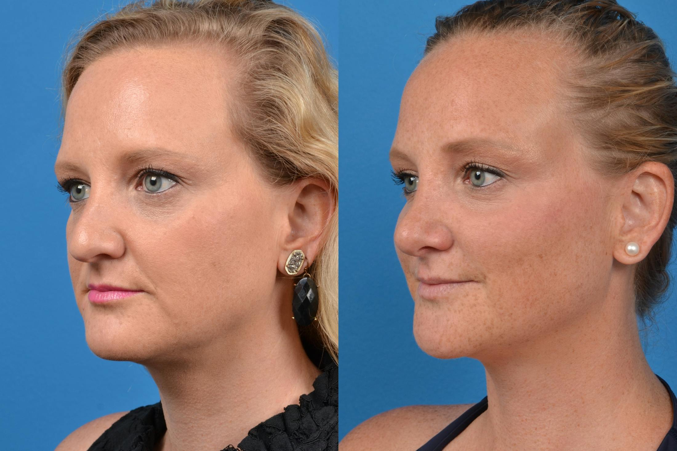 Rhinoplasty Before & After Gallery - Patient 122406552 - Image 4