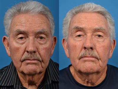 Profile Neck Lift Before & After Gallery - Patient 122406551 - Image 1