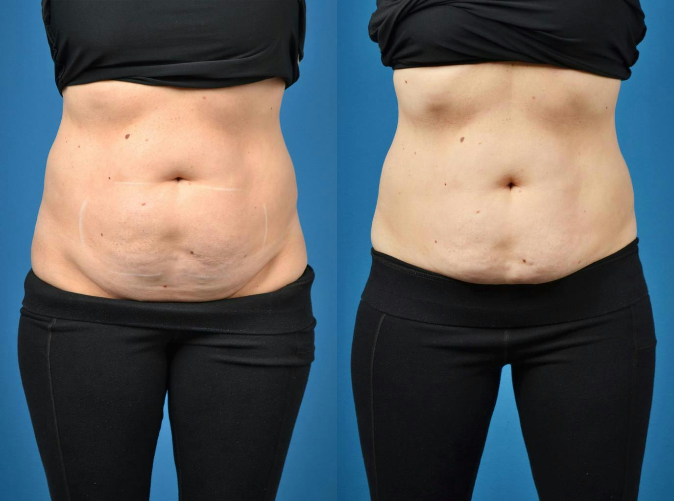 SculpSure Body Contouring Gallery - Patient 122406546 - Image 1