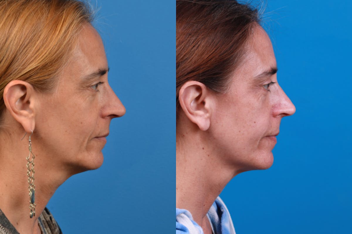 Laser Assisted Weekend Neck Lift Before & After Gallery - Patient 122406547 - Image 5