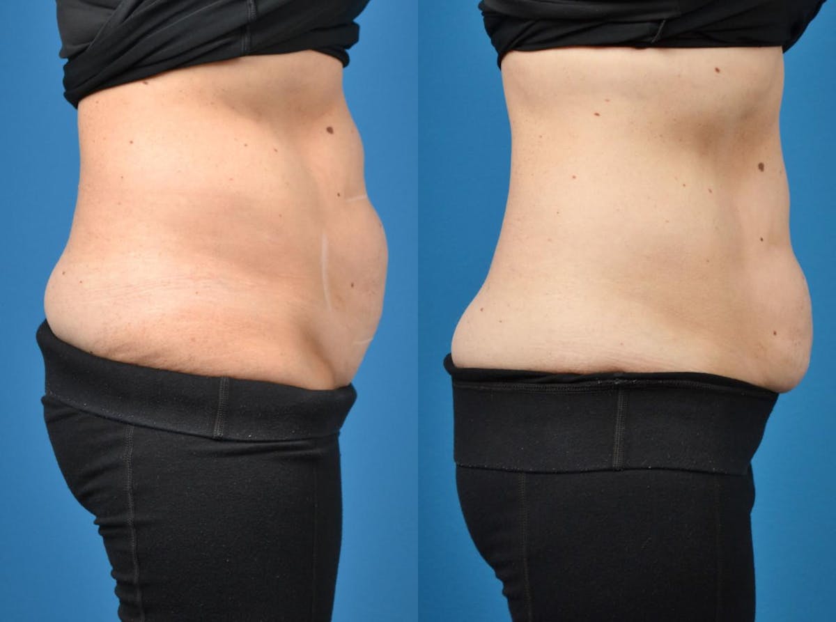 SculpSure Body Contouring Before & After Gallery - Patient 122406546 - Image 2