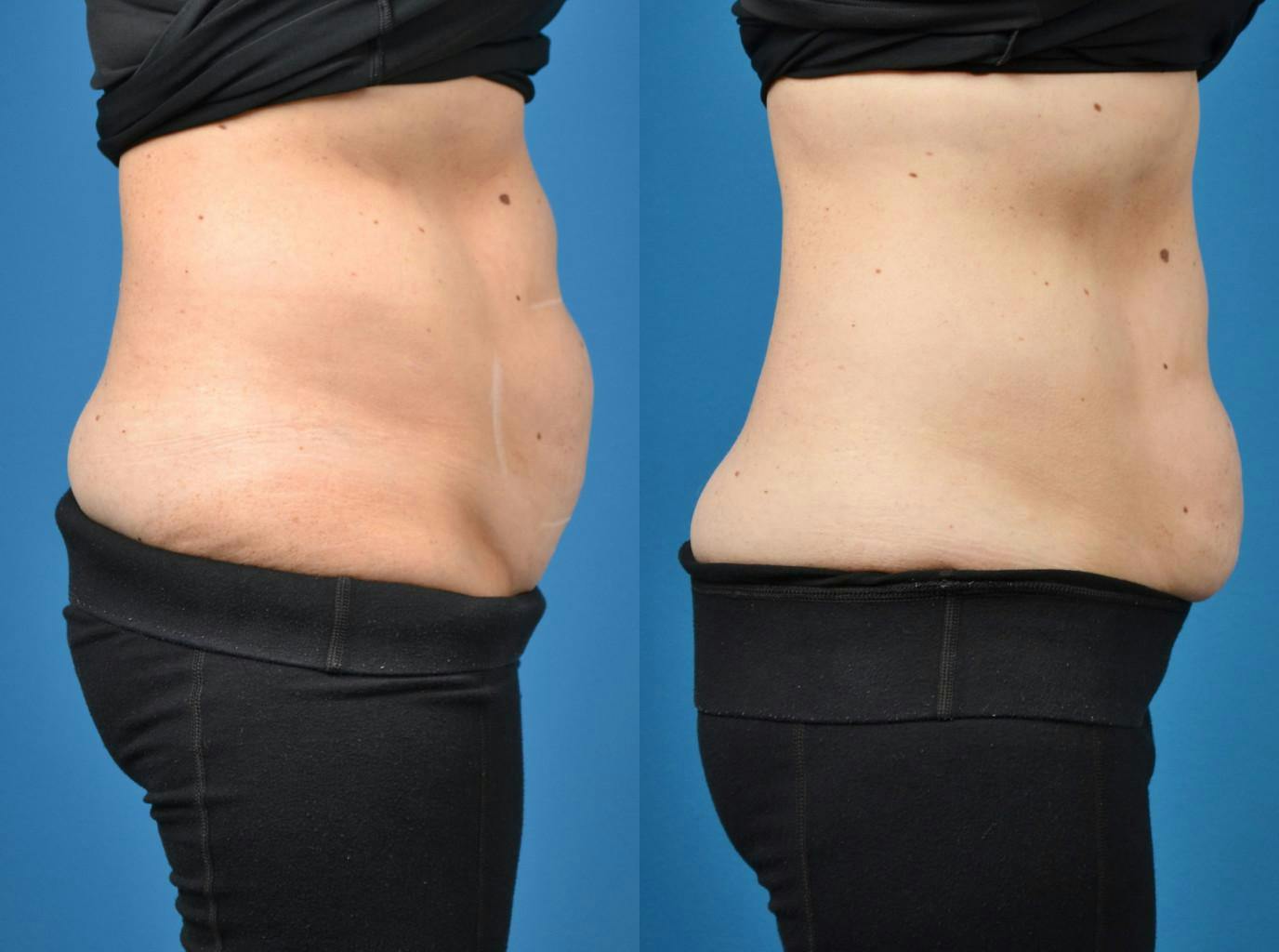 SculpSure Body Contouring Gallery - Patient 122406546 - Image 2