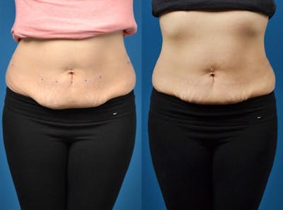 SculpSure Body Contouring Before & After Gallery - Patient 122406548 - Image 1