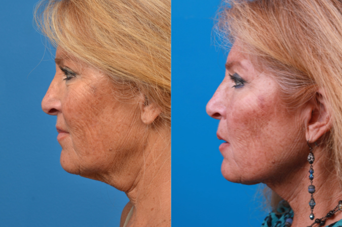 Laser Assisted Weekend Neck Lift Before & After Gallery - Patient 122406549 - Image 1