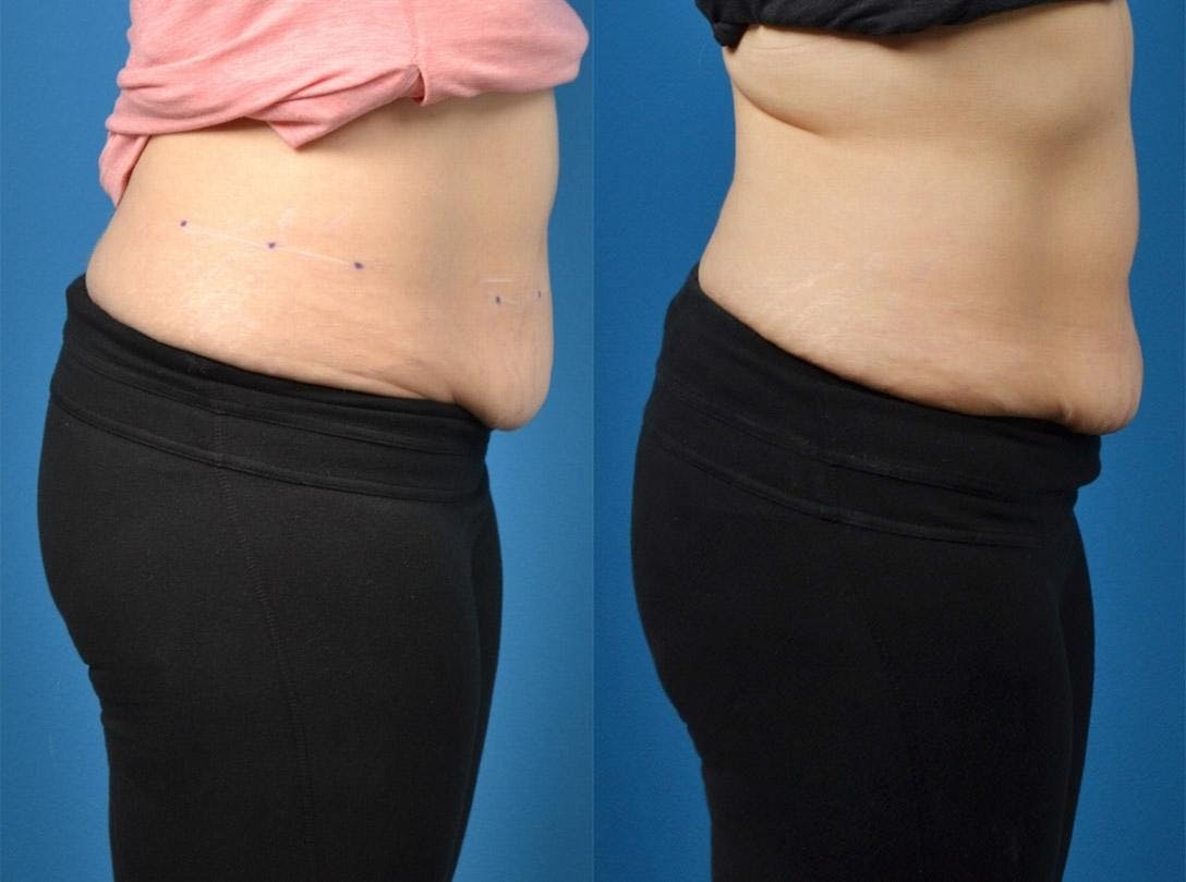 SculpSure Body Contouring Before & After Gallery - Patient 122406548 - Image 2