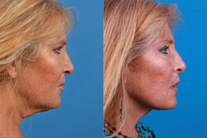 Laser Assisted Weekend Neck Lift Before & After Gallery - Patient 122406549 - Image 2