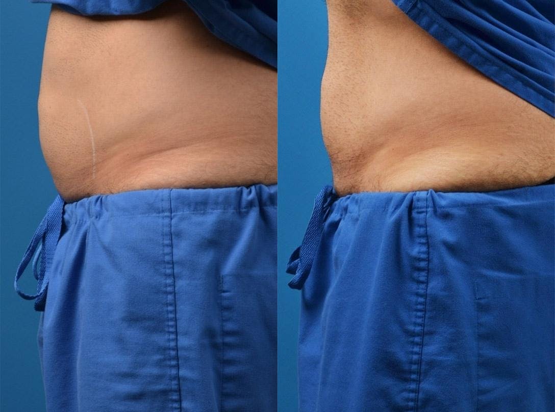 SculpSure Body Contouring Gallery - Patient 122406550 - Image 1