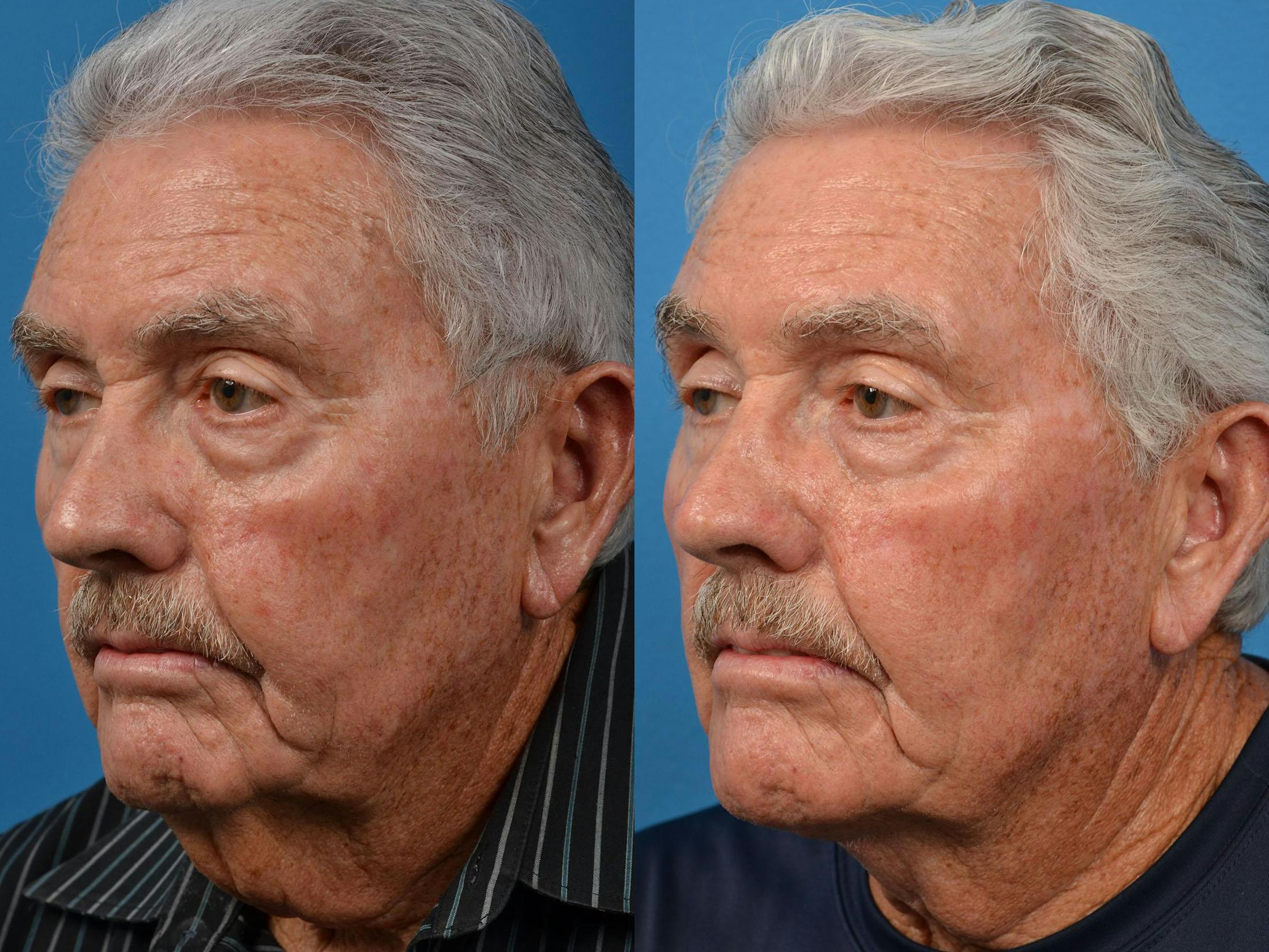 Profile Neck Lift Before & After Gallery - Patient 122406551 - Image 4