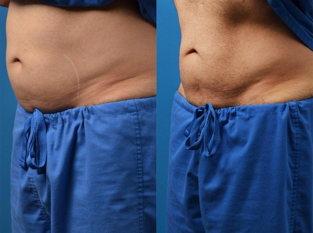 SculpSure Body Contouring Gallery - Patient 122406550 - Image 2