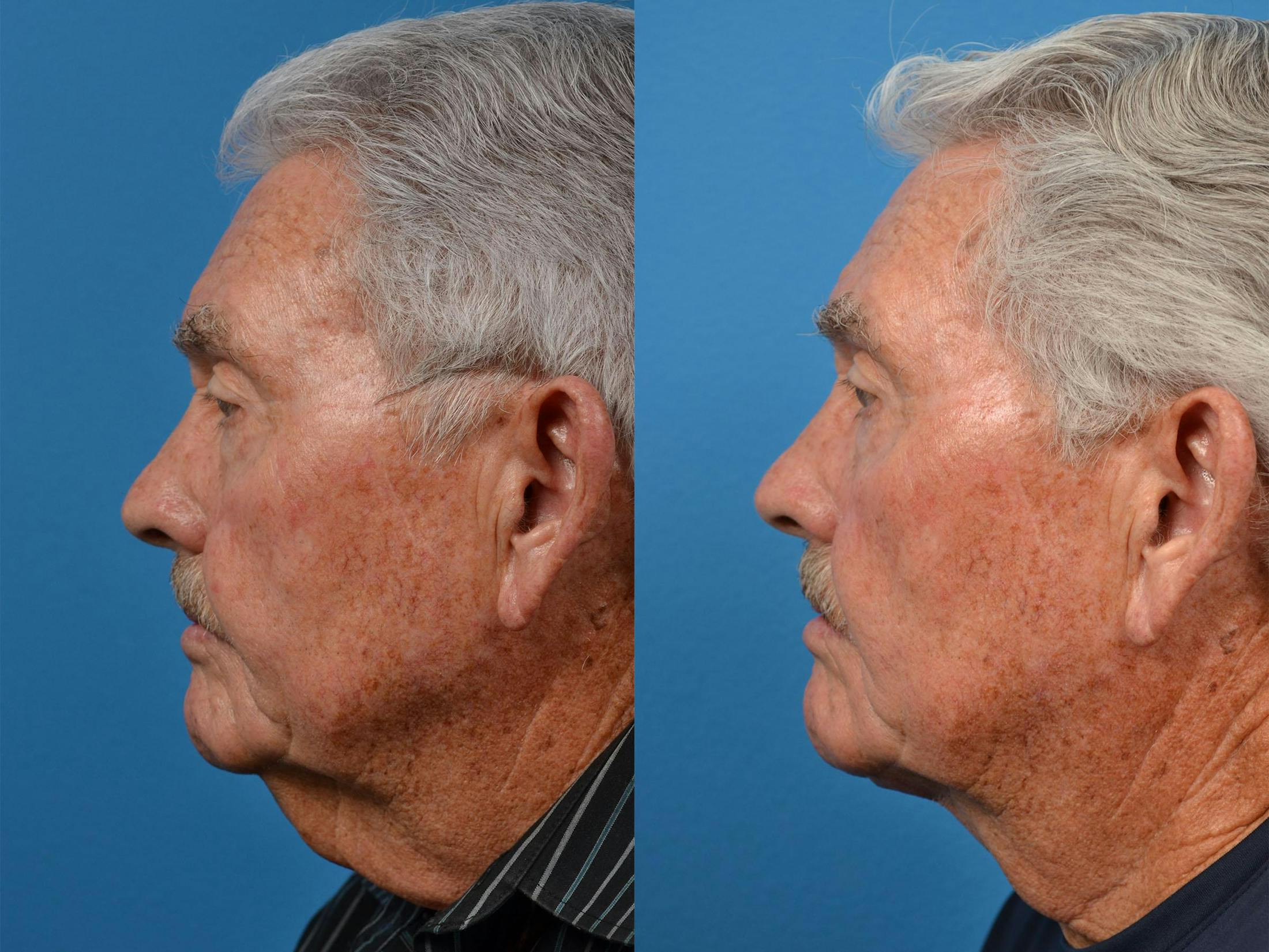 Profile Neck Lift Before & After Gallery - Patient 122406551 - Image 5