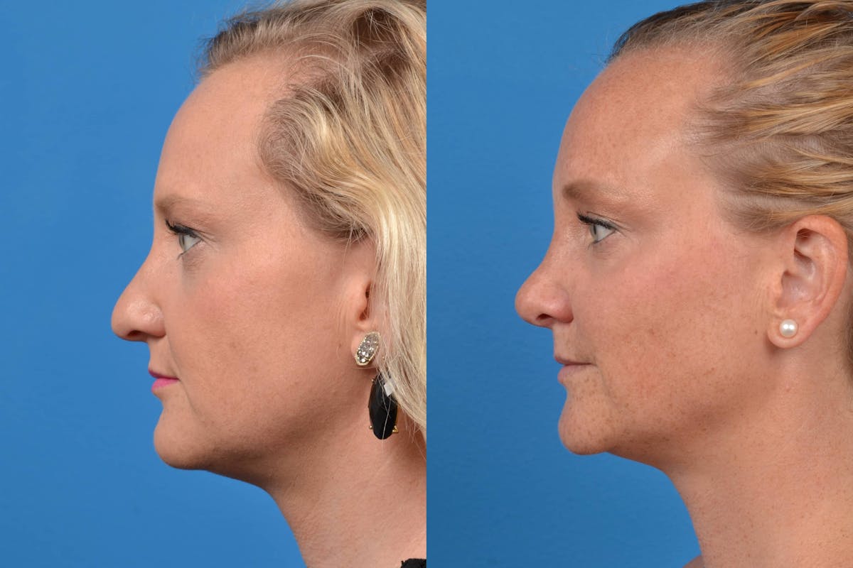 Rhinoplasty Before & After Gallery - Patient 122406552 - Image 5