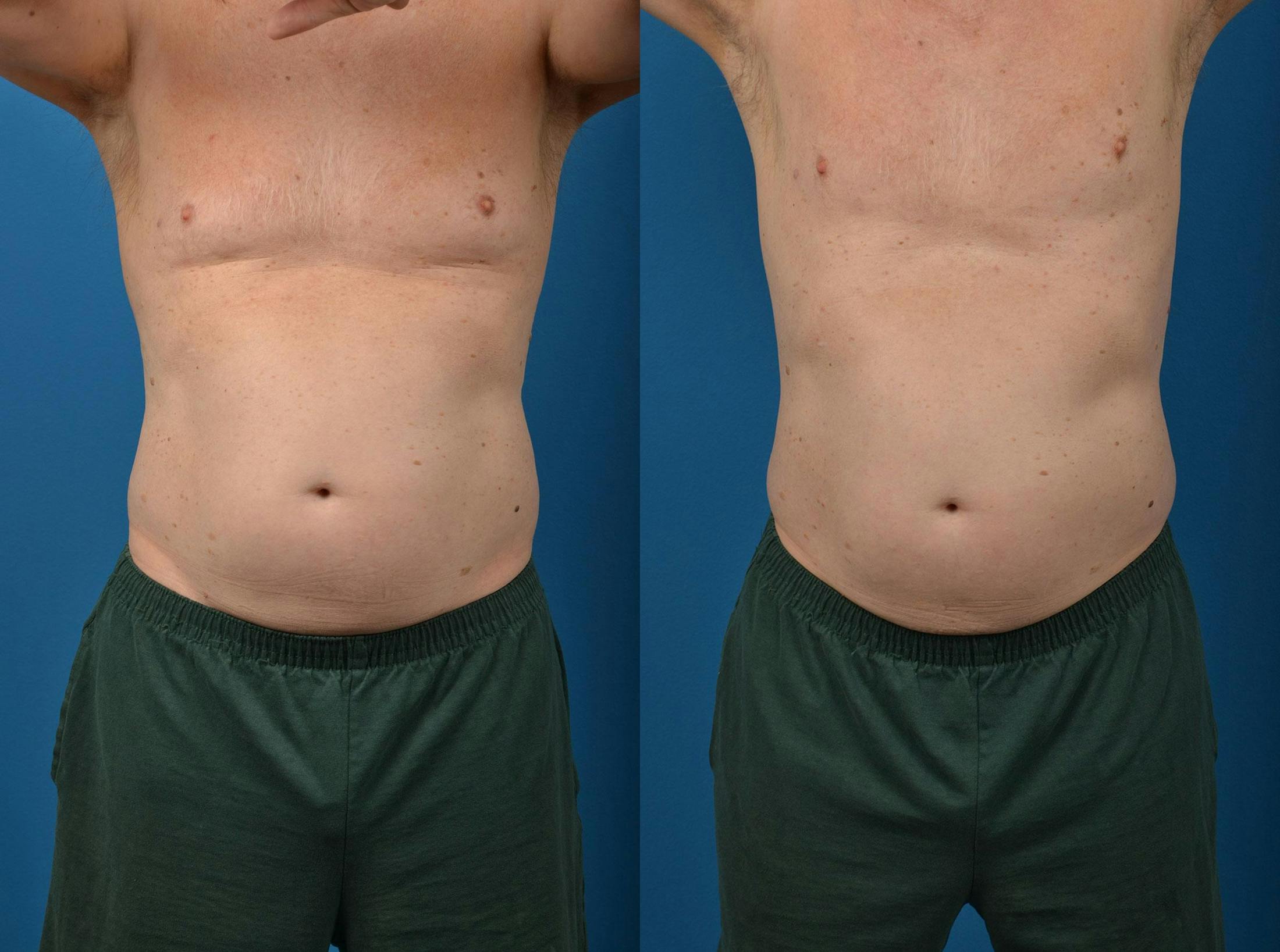 SculpSure Body Contouring Before & After Gallery - Patient 122406553 - Image 1