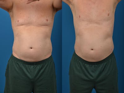 SculpSure Body Contouring Before & After Gallery - Patient 122406553 - Image 1