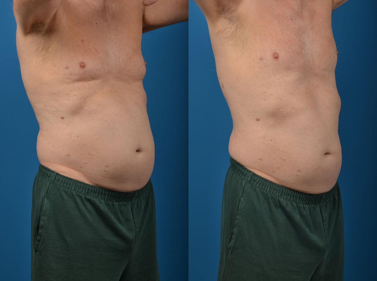 SculpSure Body Contouring Before & After Gallery - Patient 122406553 - Image 2