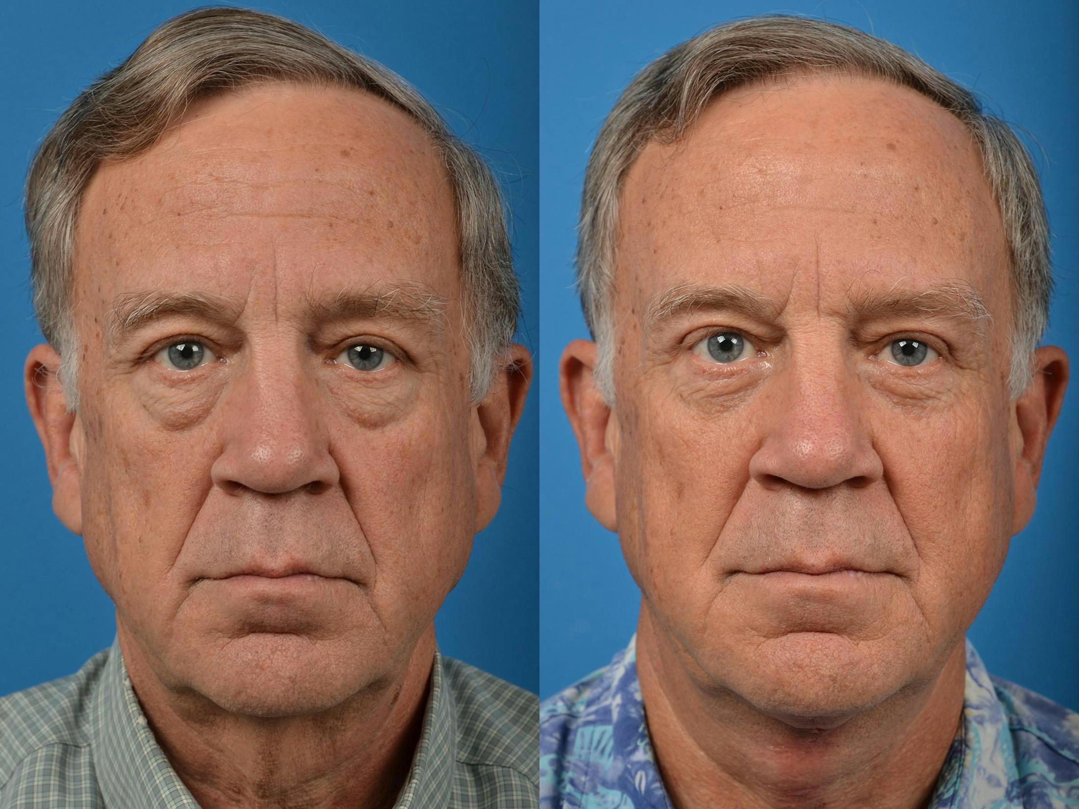Profile Neck Lift Before & After Gallery - Patient 122406555 - Image 1