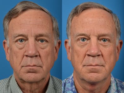 Profile Neck Lift Before & After Gallery - Patient 122406555 - Image 1