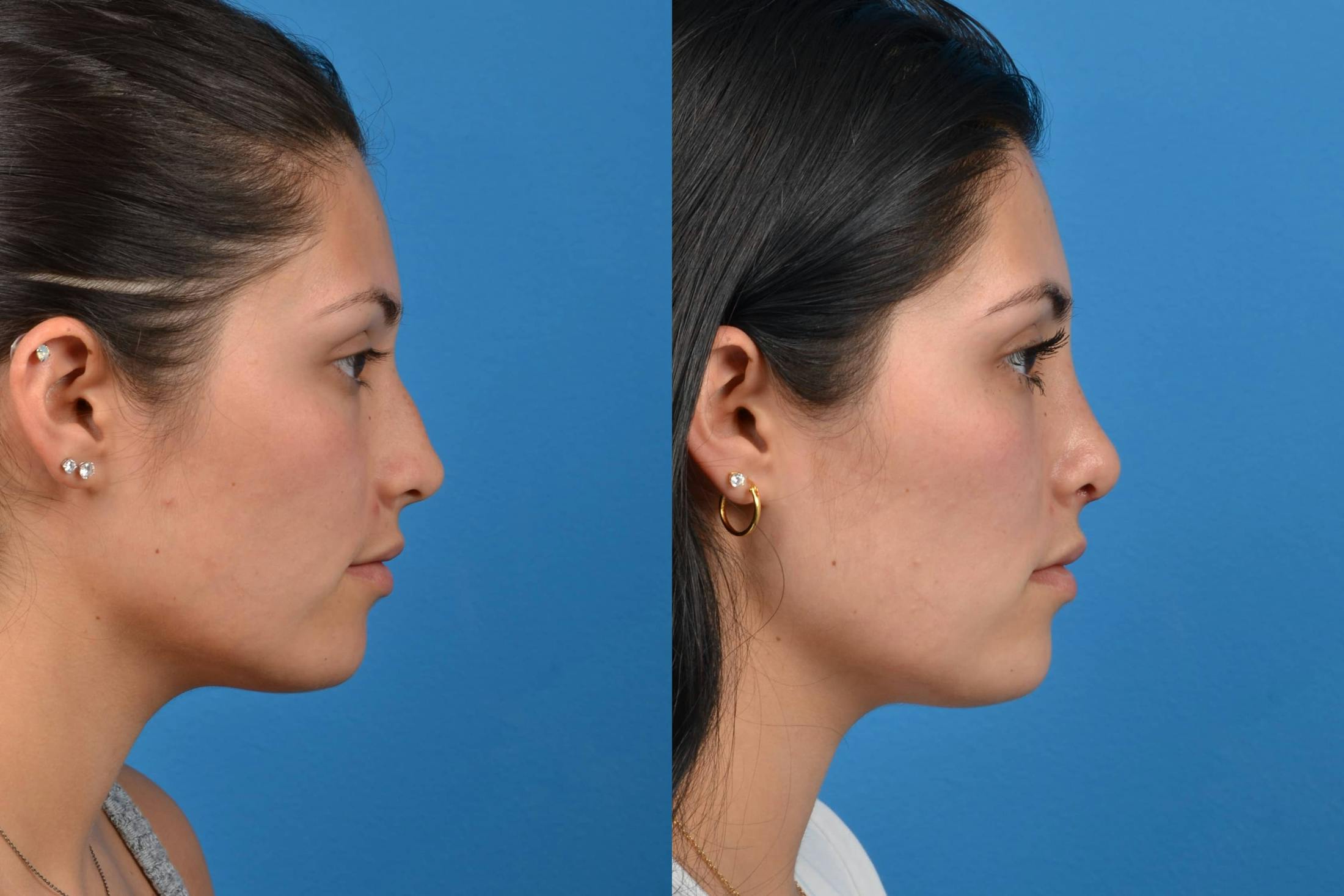 Rhinoplasty Before & After Gallery - Patient 122406554 - Image 1