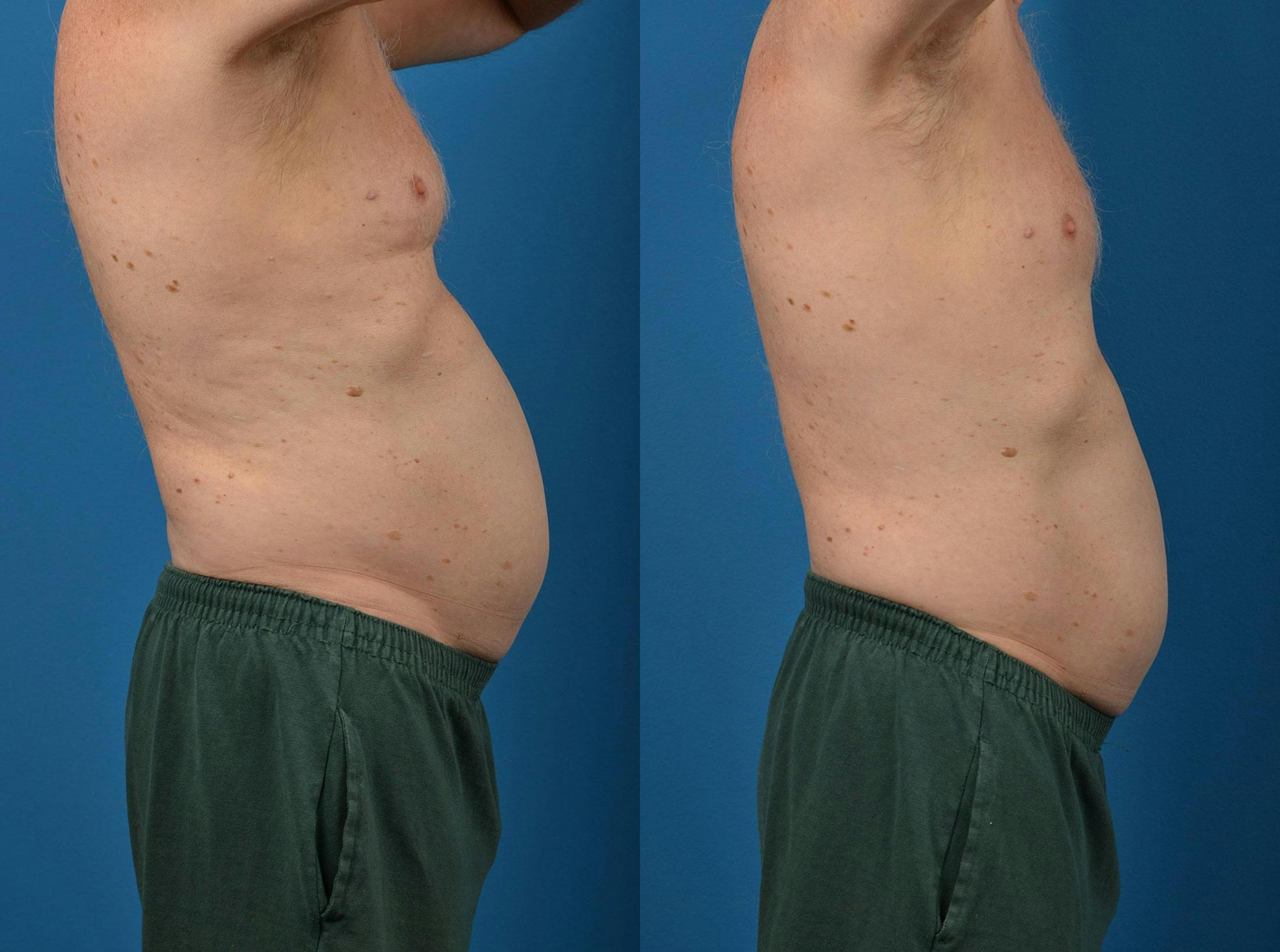 SculpSure Body Contouring Before & After Gallery - Patient 122406553 - Image 3