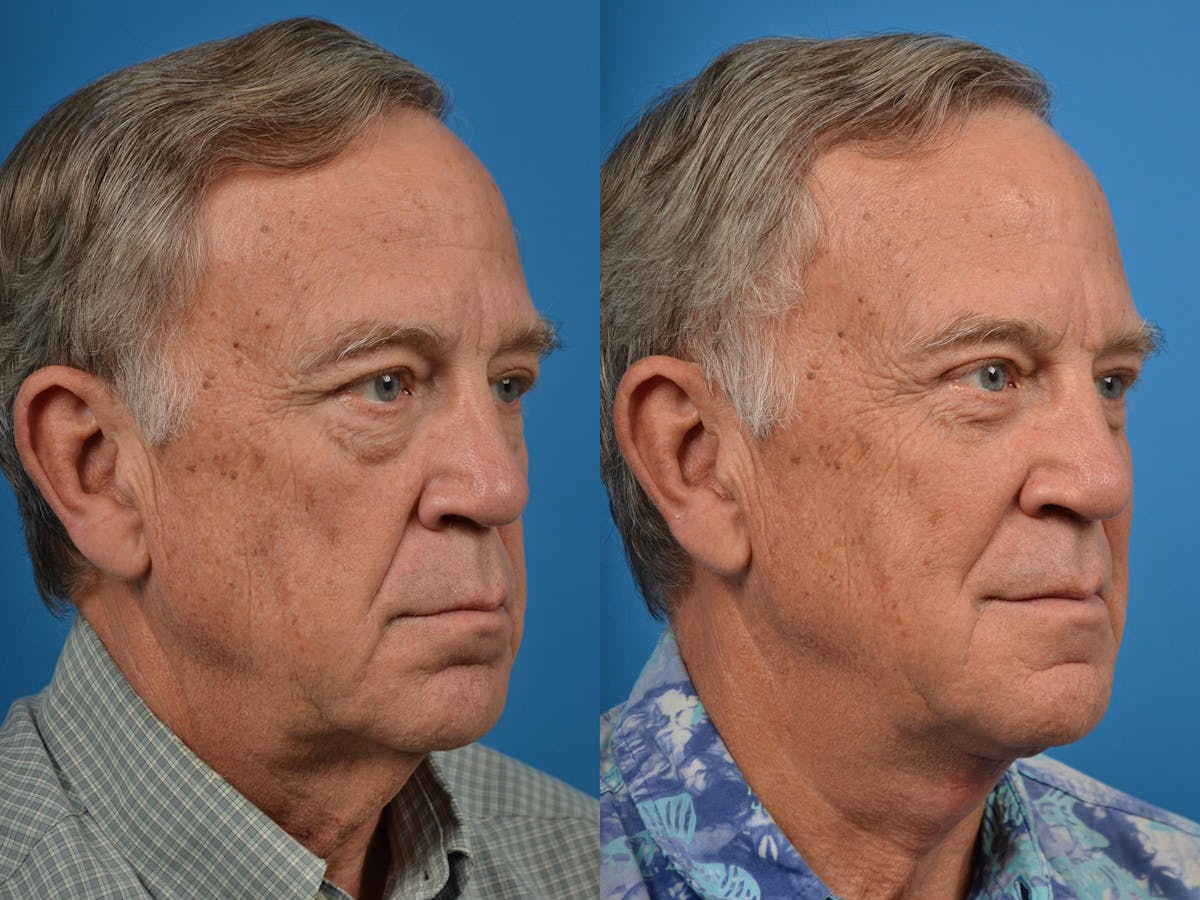 Profile Neck Lift Before & After Gallery - Patient 122406555 - Image 2